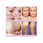 Gn Derma Roller HG