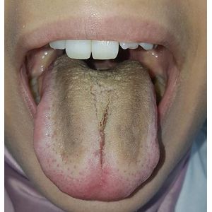 Racloir à Langue pour Hygiène Buccale – 1 PCS