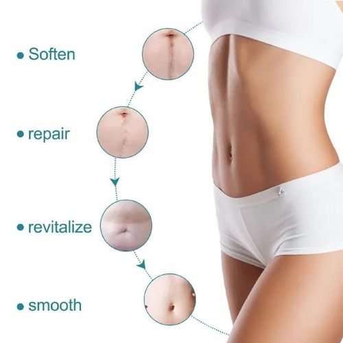 product_image_name-Generic-2Roll Feuilles de cicatrices en silicone Bandes d'enlèvement de bosses keloïdes, traitements de réduction des cicatrices Cicatrices chirurgicales, brûlures, tummy tucks, acné, C-section-5