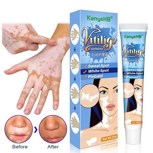 Generic Vitiligo Crème - Prix pas cher | Jumia CI